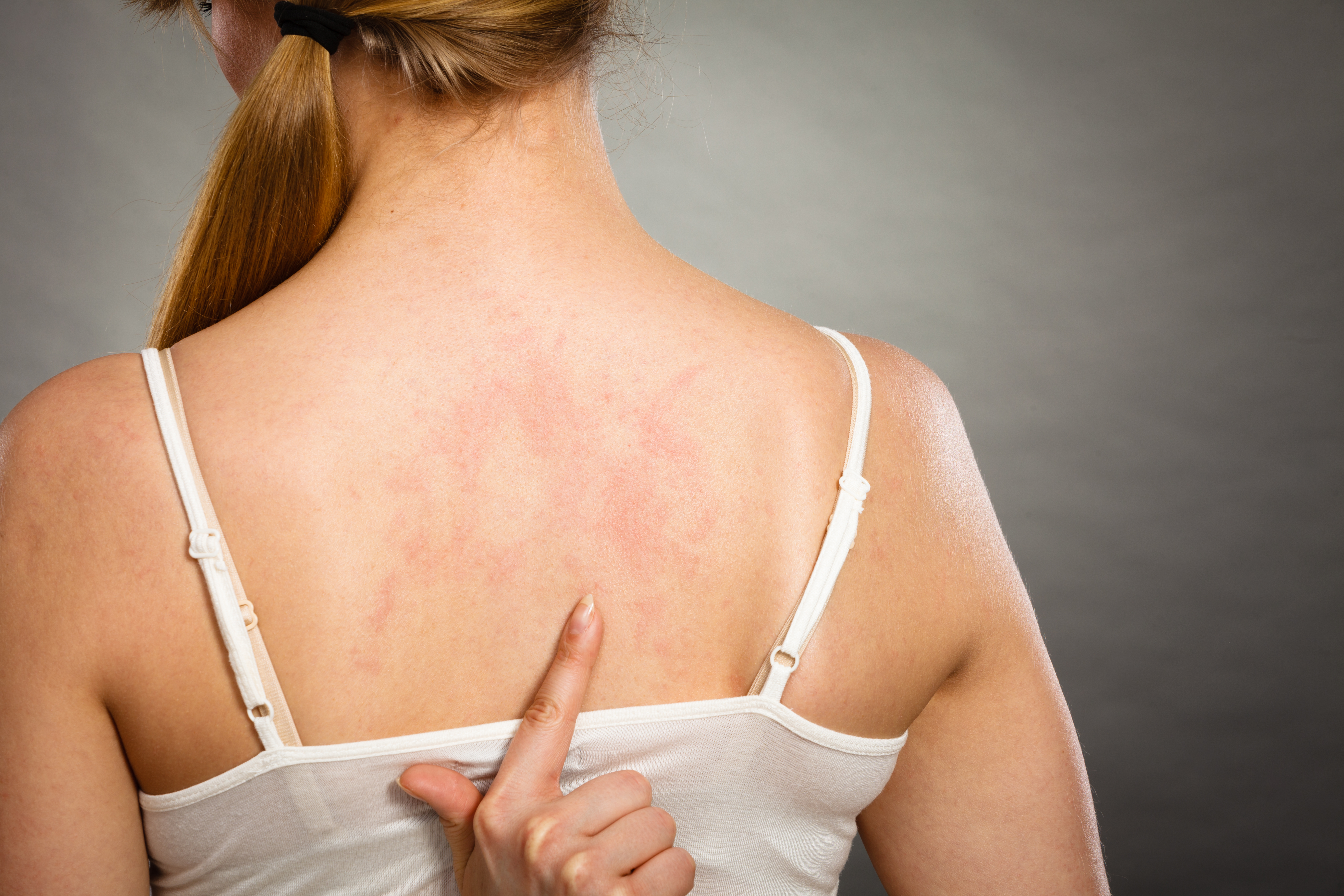 皮肤病轻女子表现出背部瘙痒过敏皮疹荨麻疹症状女人用过敏皮疹抓痒