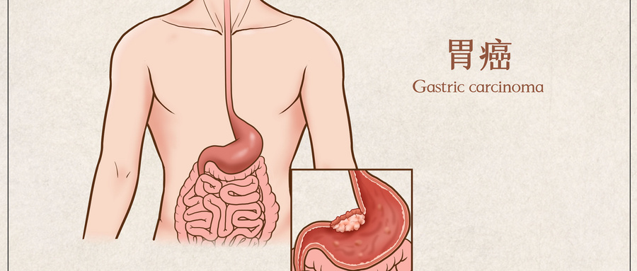 摄图网_401789678_wx_胃癌医疗插画（企业商用）.jpg