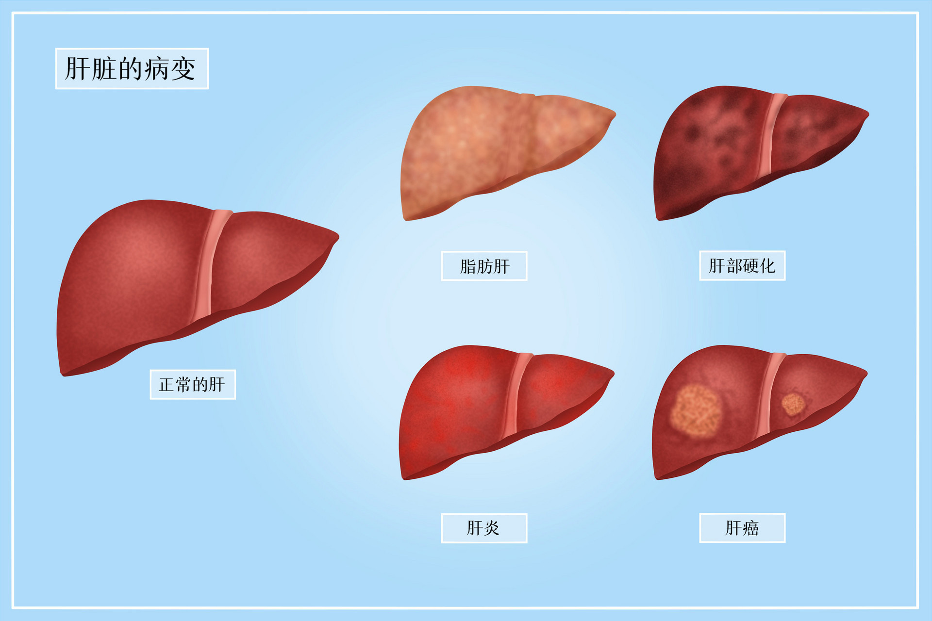 肝囊肿是怎么回事图片