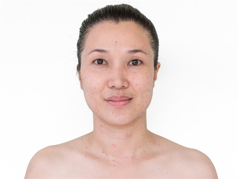 摄图网_308048790_医疗的亚洲妇女脸部和颈的烧焦点或激光处理蜡烛皮肤雀斑和黑在燃烧激光处理后头发皮肤科医生（企业商用）.jpg