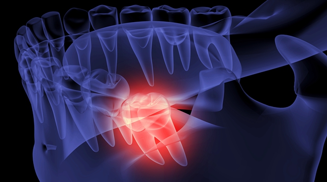 摄图网_401900314_口腔智齿疼痛（企业商用）.jpg