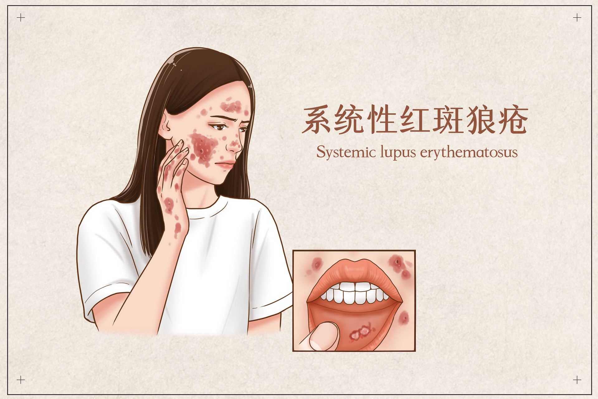 摄图网_401794490_系统性红斑狼疮医疗插画(企业商用).jpg