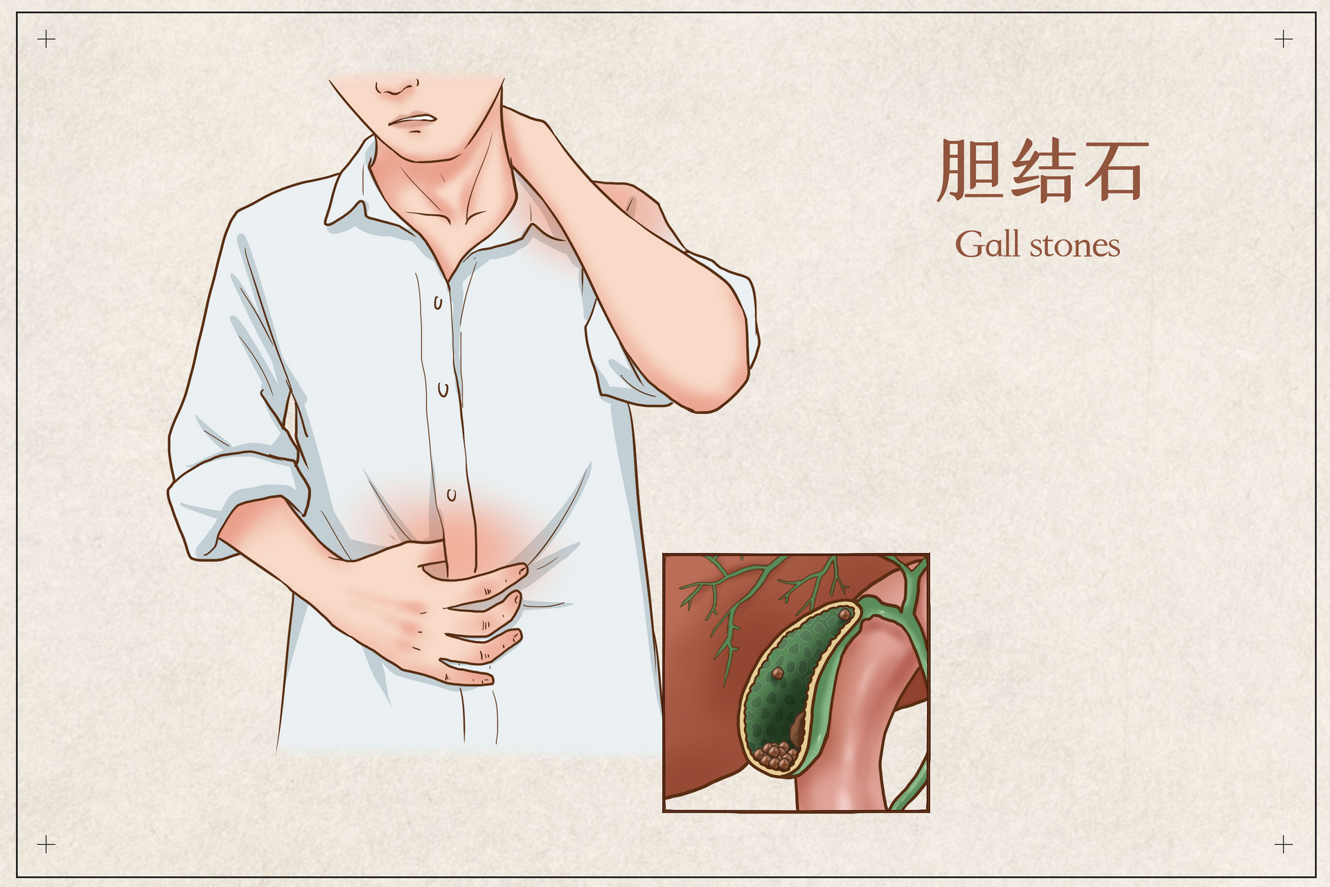 摄图网_401804065_胆结石医疗插画(企业商用).jpg